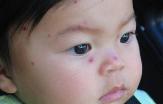 水痘可以吃瓜吗